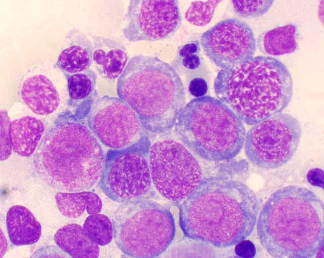Síndrome Mielodisplásica : Uma doença hemato-oncológica – Emília Cortesão Síndrome Mielodisplásica : Uma doença hemato-oncológica – Emília Cortesão