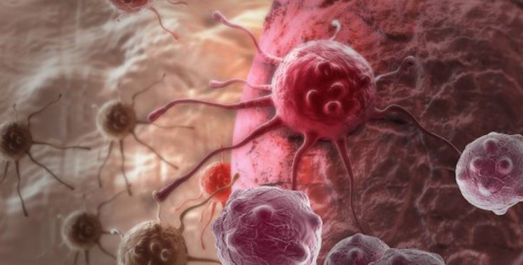 Tempos de espera e desvalorização de sintomas podem pôr em causa a vida de doentes com cancro do pâncreas Tempos de espera e desvalorização de sintomas podem pôr em causa a vida de doentes com cancro do pâncreas