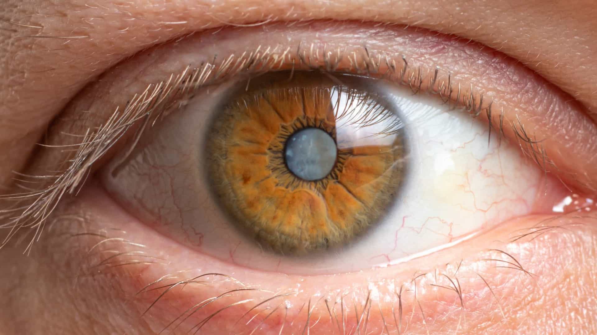 Cegueira e deficiência visual aumentam a nível mundial devido às cataratas