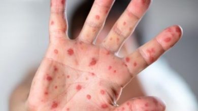 DGS confirma 27 casos de sarampo em Portugal