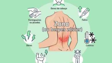 A Zona não é só uma borbulha: é uma dor que pode ficar – Por Dr. Eurico Silva