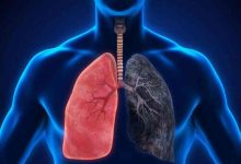 O Cancro do Pulmão Não Tira Férias: O peso invisível da doença O Cancro do Pulmão Não Tira Férias: O peso invisível da doença